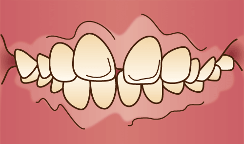 上下顎前突（じょうかがくぜんとつ）