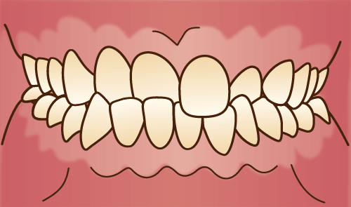交叉咬合（こうさこうごう）