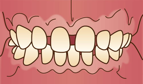 空隙歯列（くうげきしれつ）